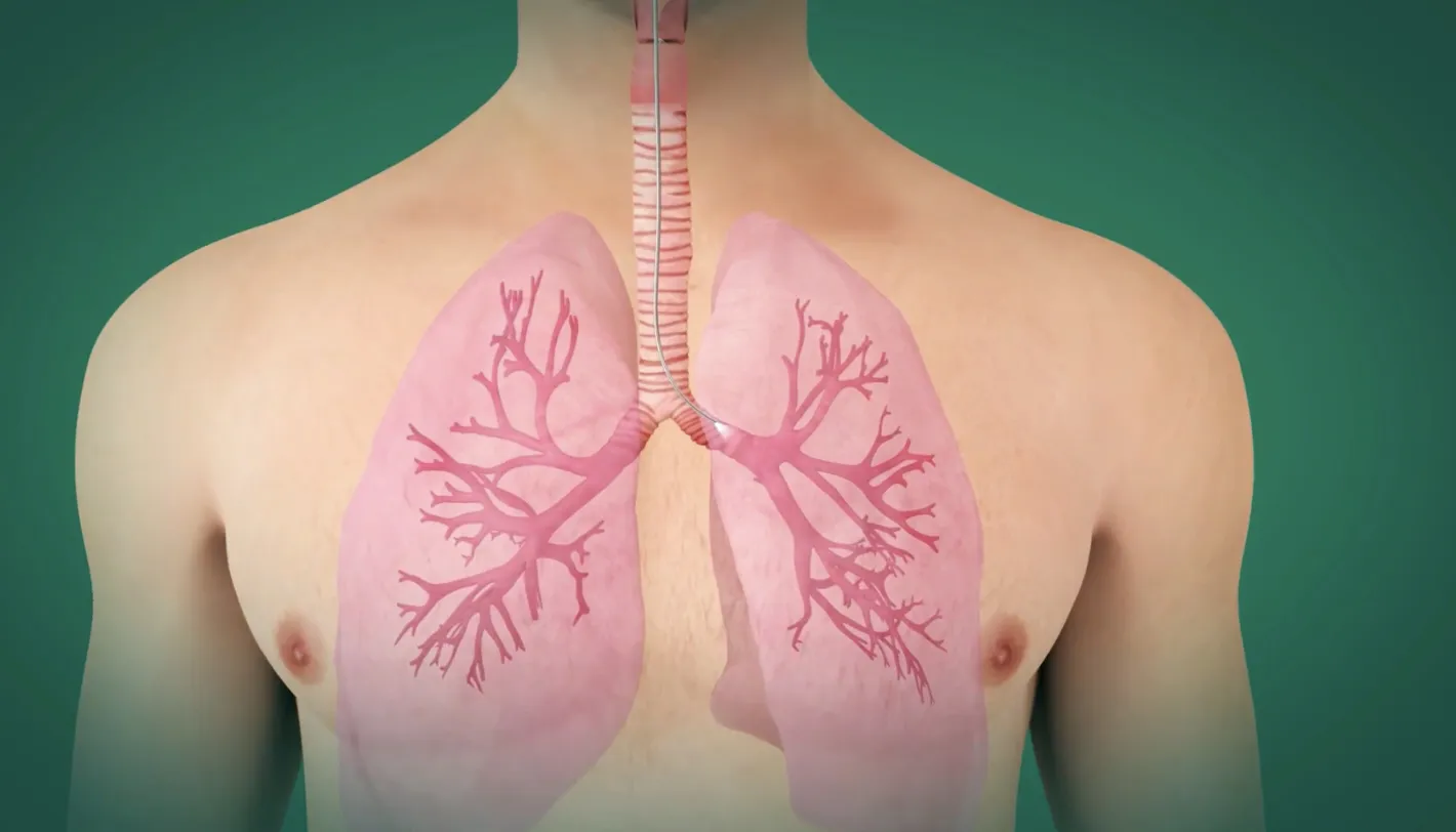 Grâce à une technique mini-invasive, Hepta Medical a mis au point un mode d'ablation pour les petites tumeurs dans le cancer du poumon.